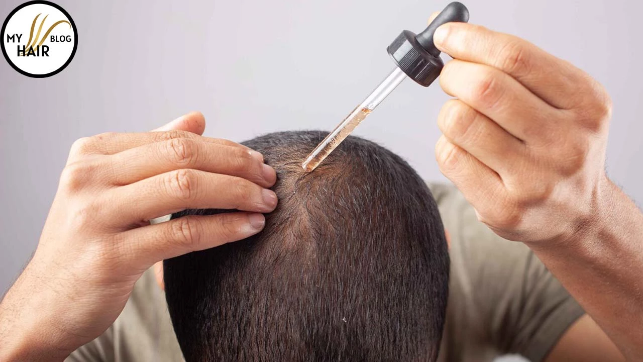 How to stop Minoxidil without Losing Hair?