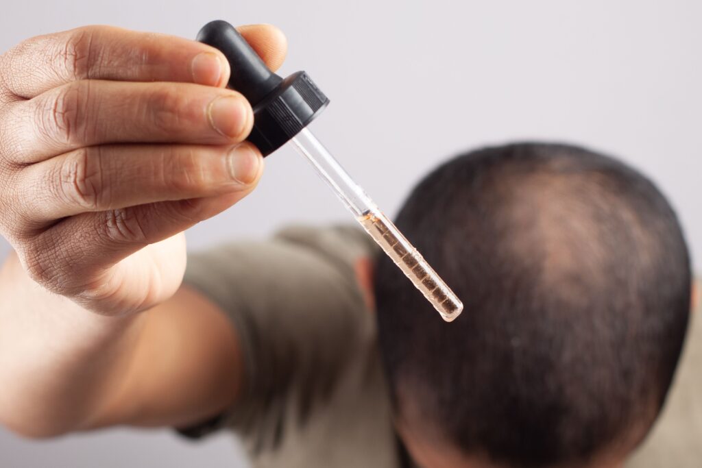 man using minoxidil to treat male patter baldness