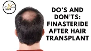 Do's and Don'ts: Finasteride After Hair Transplant