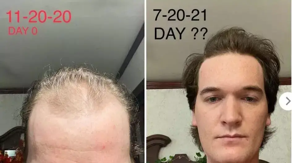 The Results after applying Minoxidil
