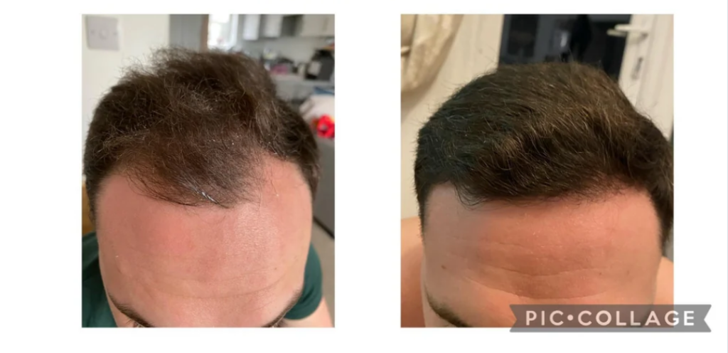 Temple head results after applying minoxidil for 10 months