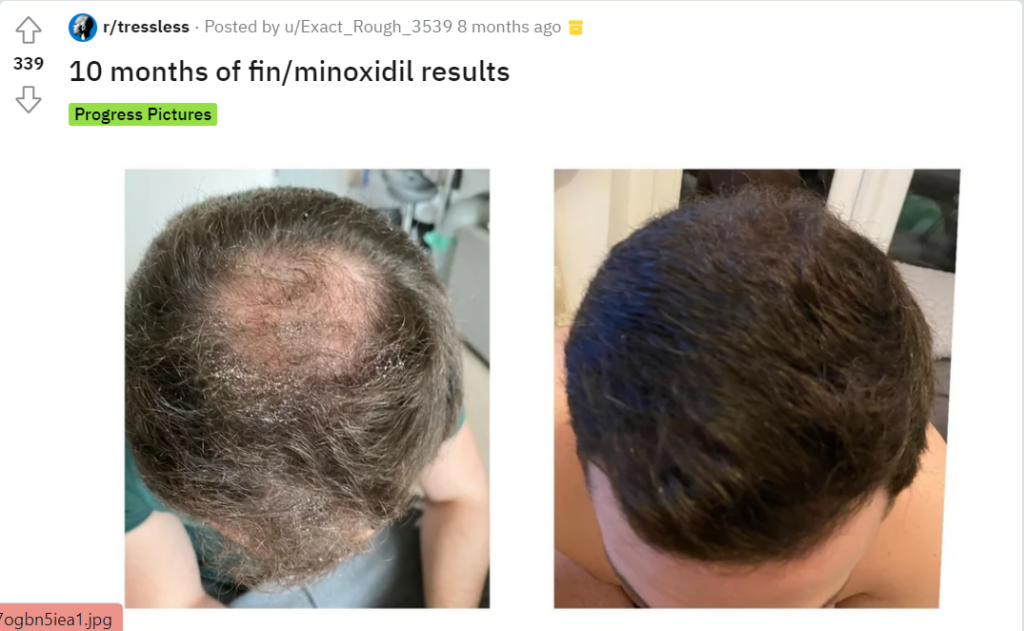 Crown head Results after applying minoxidil 10 months