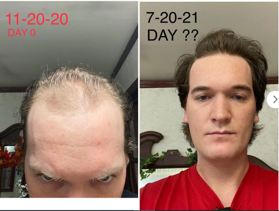 Taken from Reddit, Temple head results after applying minoxidil for 8 months