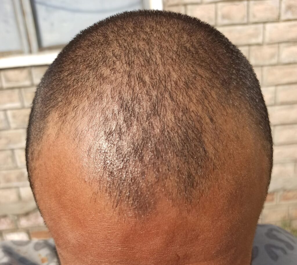 bald head before using minoxidil and derma roller